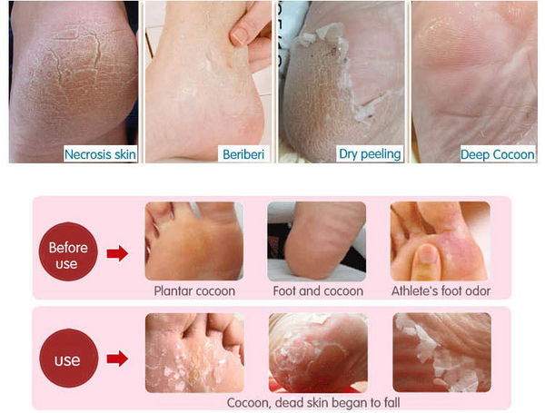 peeling hard skin on feet