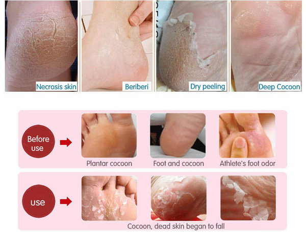 new-nur76-2017-exfoliating-peeling-hard-dead-skin-on-feet-foot-mask-r