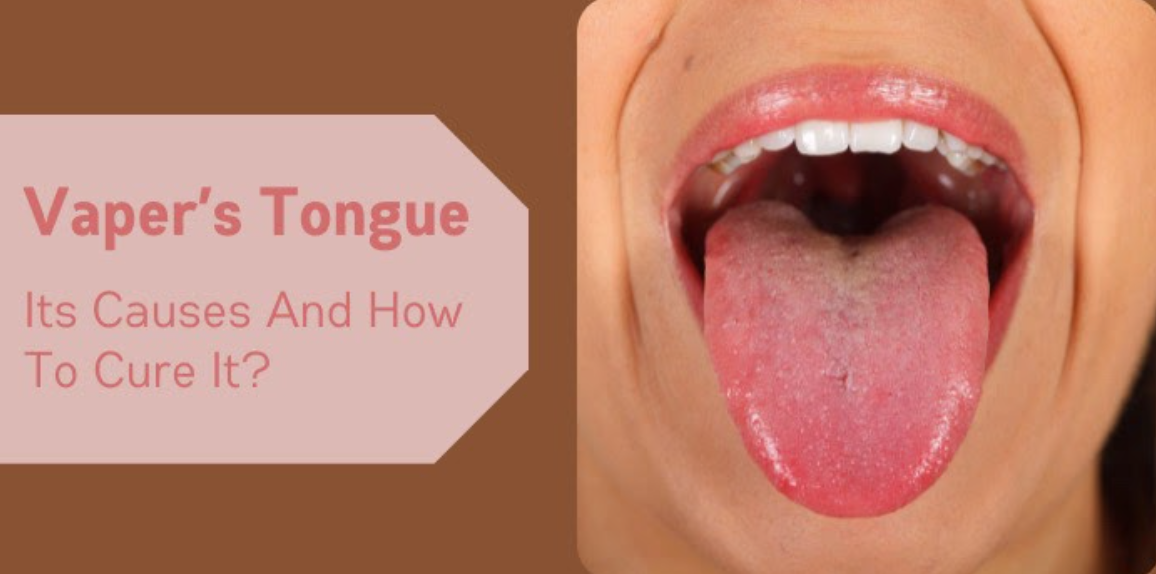 Vaper's Tongue: Causes And How To Cure It?
