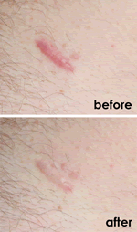 Kelo-cote before and After Picture - askderm