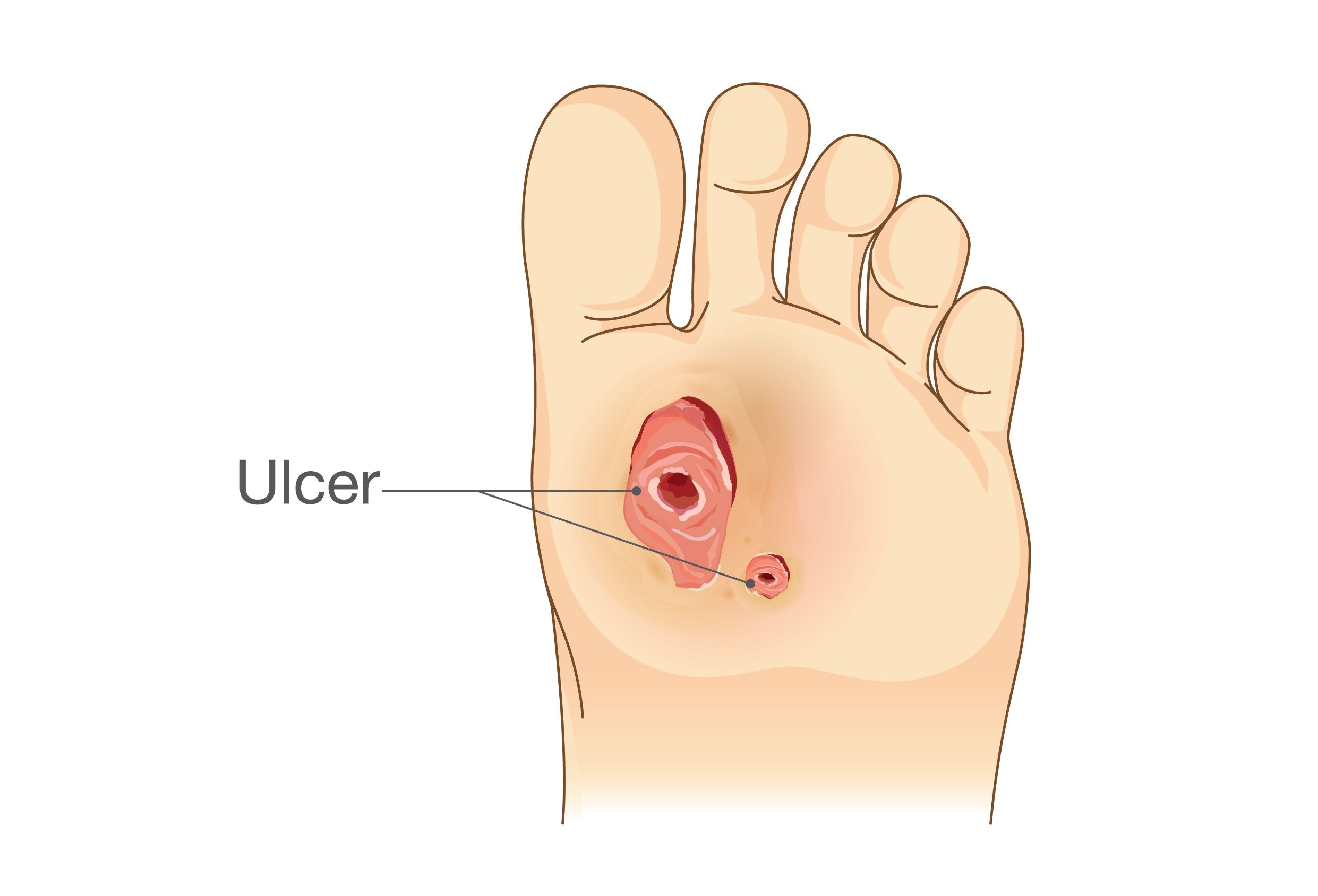 diabetic foot ulcer stages