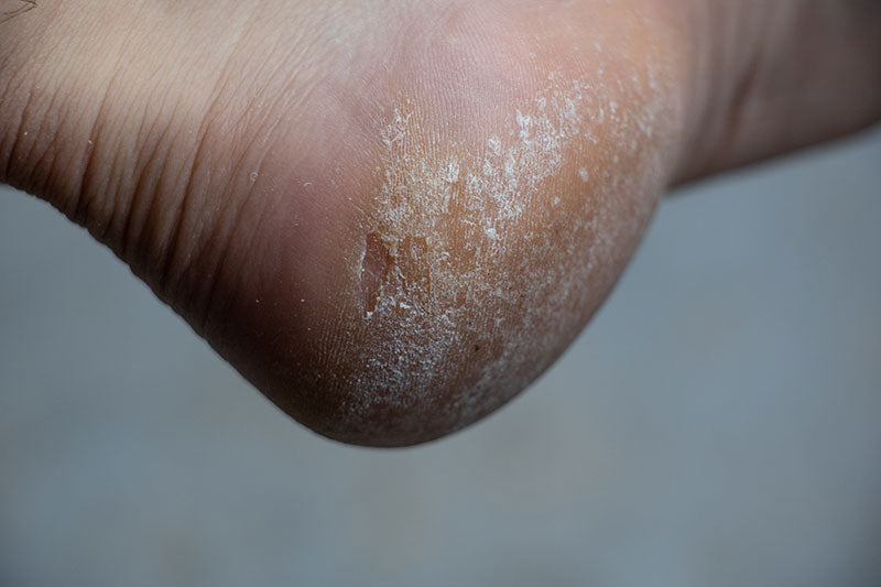 callus on toes