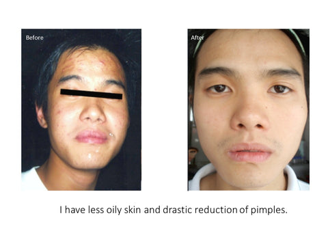 eumora soap testimonial for pimples