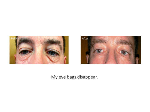 eumora soap testimonial for eye bags