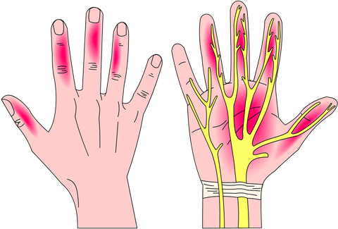 First Signs of Carpal Tunnel Syndrome numbness and pain in fingers, palm and wrist