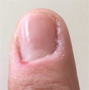 How To Prevent Dry Skin Around Nails 