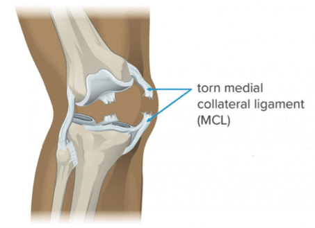  Medial Collateral Ligament (MCL).