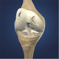 Cartilage Injury 