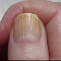 Vertical nails