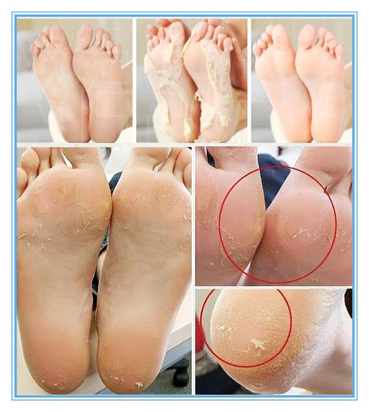 remove thick dead skin from feet