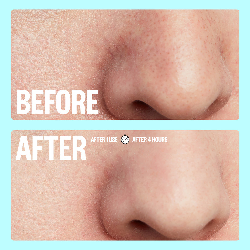 enlarged pores nose