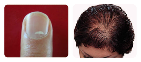 Signs of zinc deficiency. white spots on nails, white blotches on nails, hair loss zinc, hair growth zinc