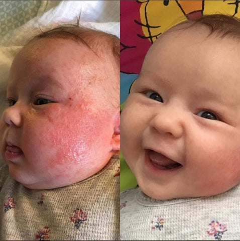 pisk Edition Net Best Creams for Eczema on Babies Faces