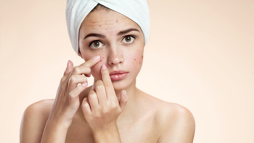 Causes of Pimples and Blackheads - and how to deal with them