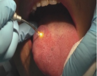 Laser therapy for oral surgery