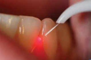 Laser therapy for dental disease