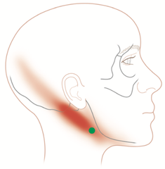 Trigger points in the digastricus