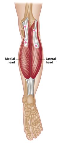 trigger point sites in the gastrocnemius
