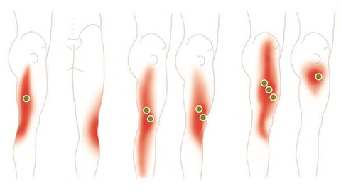 Common Trigger Point Sites and Referred Pain Maps for the Quadriceps