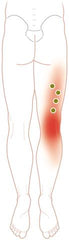 Diagram showing trigger points in the biceps femoris