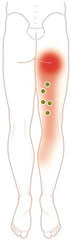 Diagram showing trigger points in the semimembranosus/semitendinosus