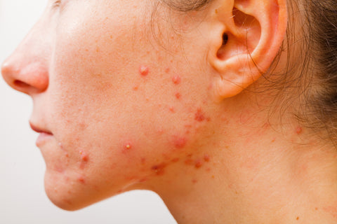 Does soy cause acne? Veise Beauty