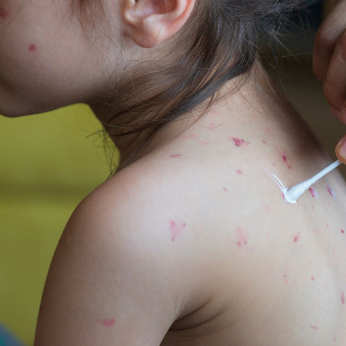 A young girl being treated for chickenpox
