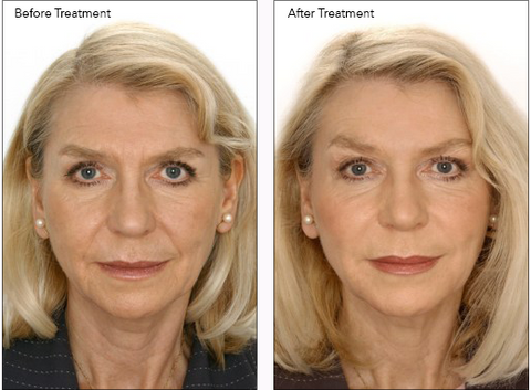 Before and After Cosmetic Injectables