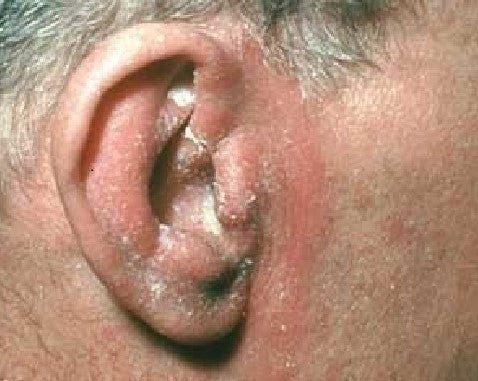 Adult Seborrheic Dermatitis: greasy, yellow/white flakes and swollen red skin around the ears