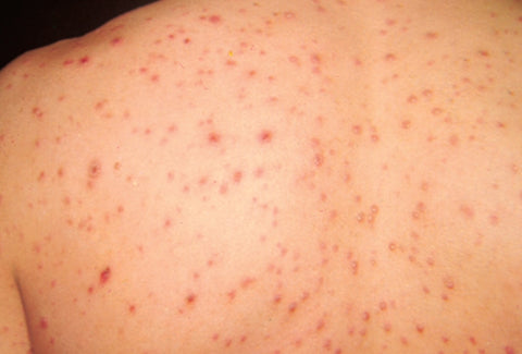 chickenpox varicella-zoster virus (VZV) rash (red bumps, blisters, and scabs)
