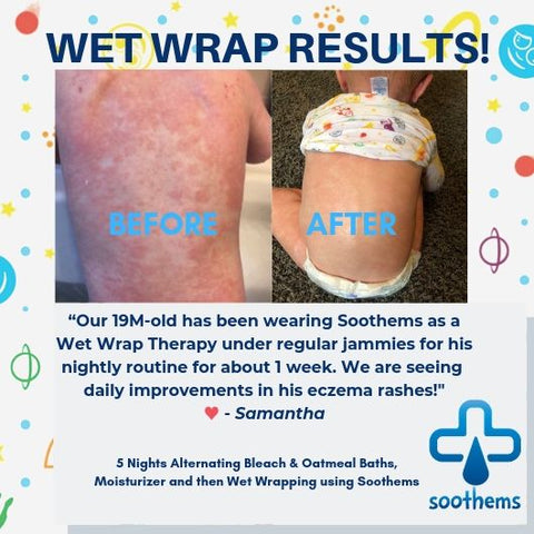 Wet wrap soothems eczema before after results