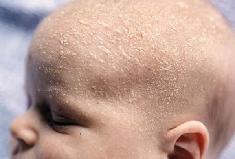Cradle Cap mostly affects infants-age 2 months - 1 year old