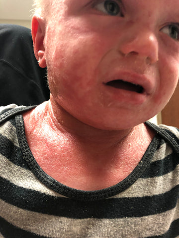 infected burning rash face eczema baby before red blisters