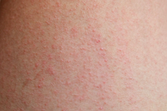 eczema skin rash