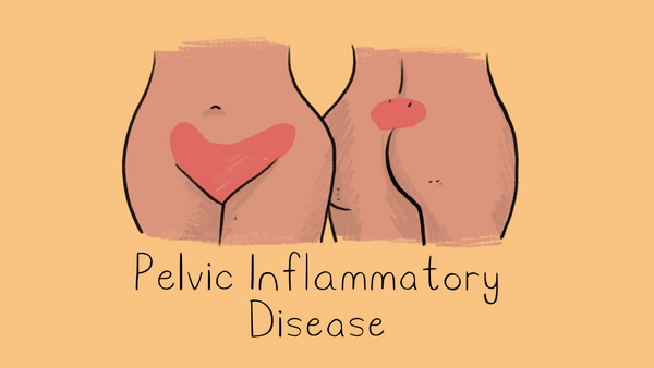 Pelvic Inflammatory Disease (PID) illustration