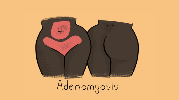 Adenomyosis illustration