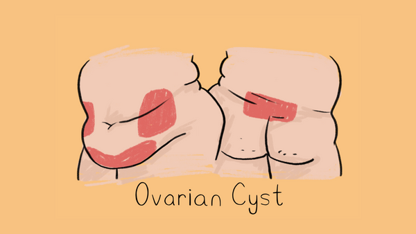 Ovarian Cyst illustration