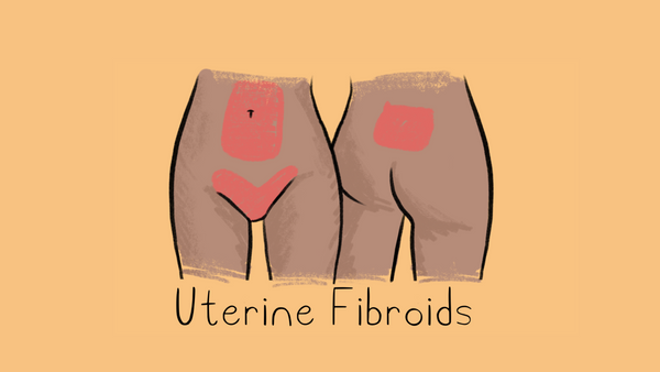 Uterine Fibroids illustration
