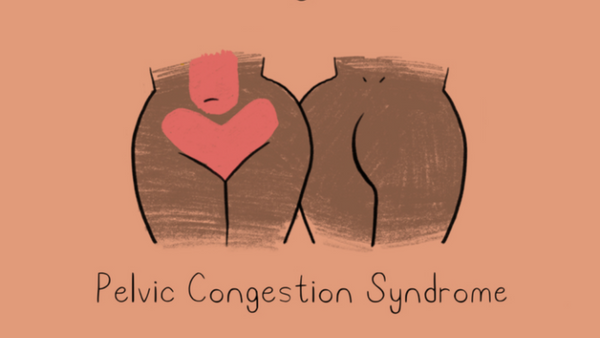 Pelvic Congestion Syndrome illustration