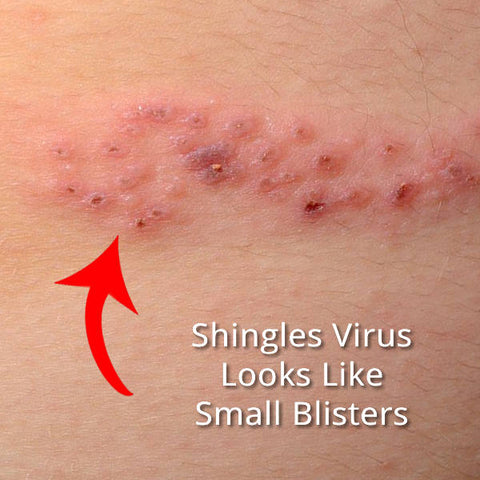 Shingles Virus Shin Rash around Torso of Body