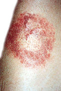 Typical Circular Rash is a Symptom of Lyme Disease