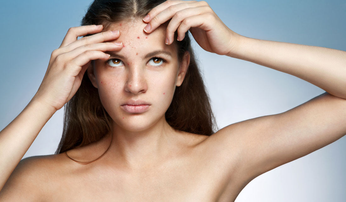 What Causes Acne Between Eyebrows amp Tiege Hanley