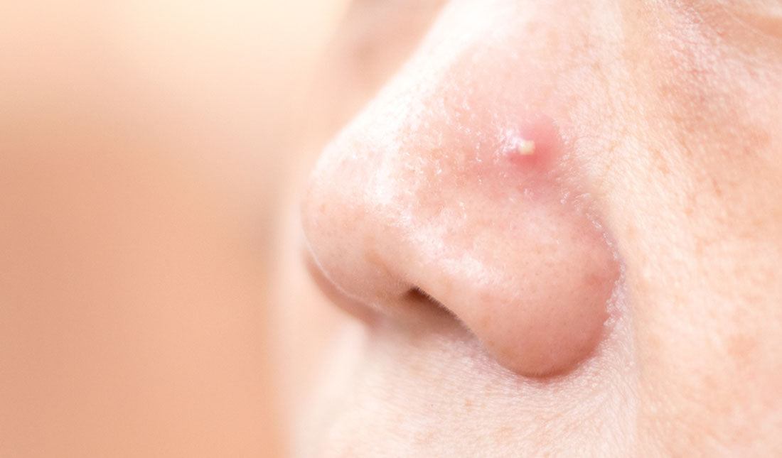 acne pimple nose closeup