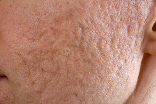 closeup deep acne scars on cheek