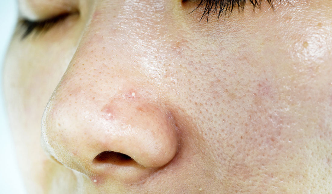 closeup skin with acne