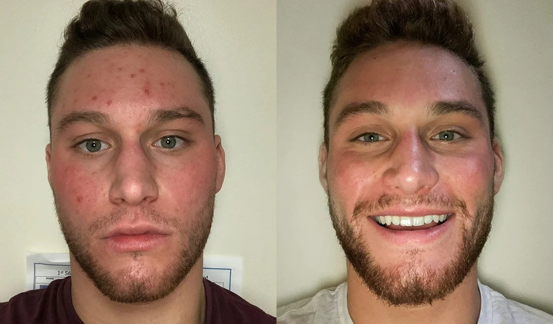 before and after using tiege hanley acne line