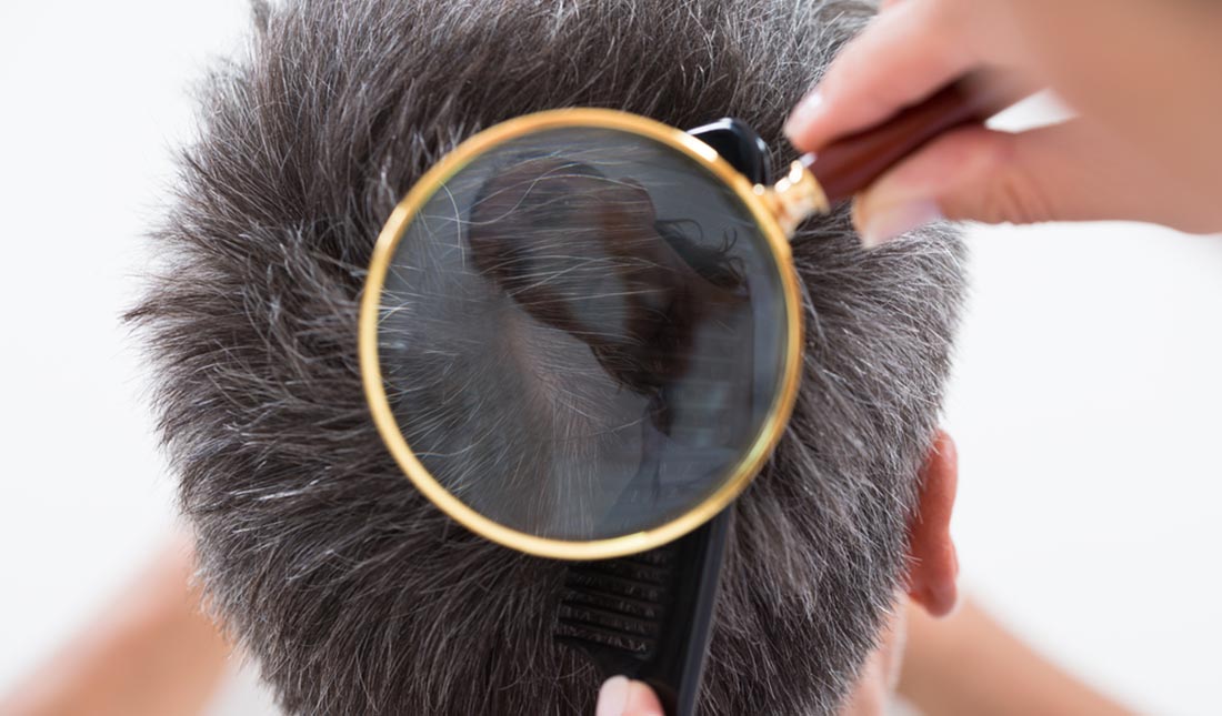 magnifying glass over mans scalp