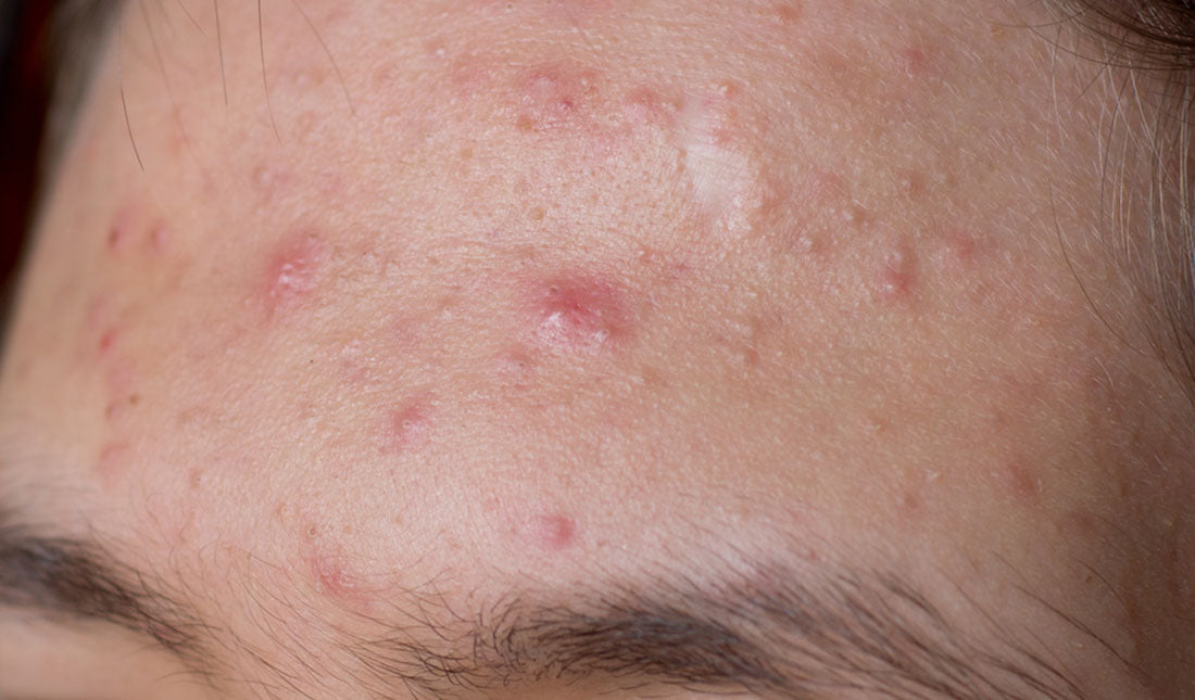 male acne on his forehead