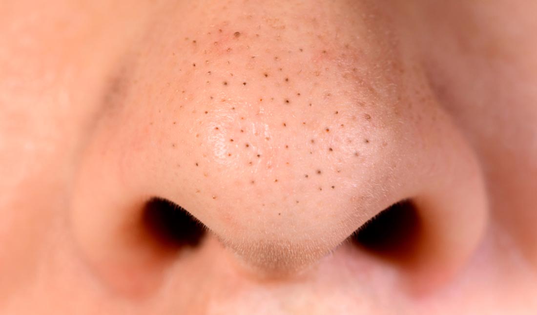 many blackheads on nose closeup