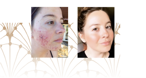 How To Heal Pimples Fast - Wabi-Sabi Botanicals